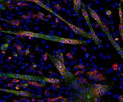 MicroARN ayuda a identificar 4 nuevas dianas para frenar el cáncer de mama